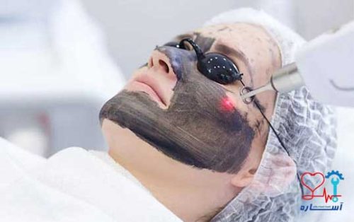 تعمیرات لیزر Q-Switch