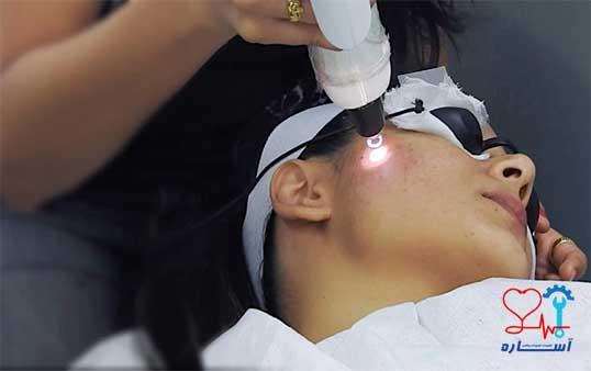 تعمیرات لیزر Q-Switch